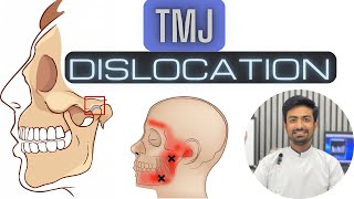 TMJ Dislocation and Management [upl. by Eelyahs754]