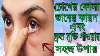 চোখের ফোলা ভাব থেকে দ্রুত মুক্তি পান। Get Rid Of Eyes Puffy Ness [upl. by Koller688]