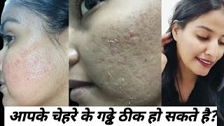 क्या आपके चेहरे के गढ्ढे ठीक हो सकते हैं Acne ScarsScars Chiken Pox Scars एक्ने स्कार्स [upl. by Cecilio674]