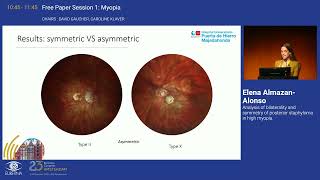 7 Analysis of bilaterality and symmetry of posterior staphyloma in high myopia [upl. by Cassondra]