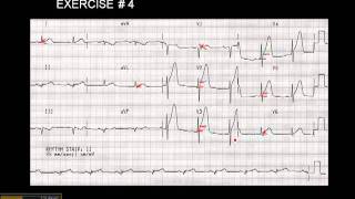 1215 Lead ECG Exercise  4 [upl. by Nahtiek598]