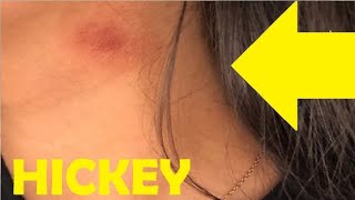 how to give someone a hickey fast and easy [upl. by Novonod]