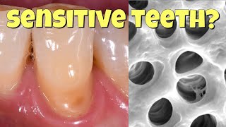 Why teeth get sensitive and how to fix it [upl. by Ramses]