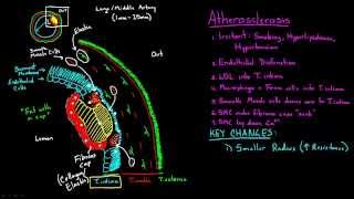 Atherosclerosis  Part 2 [upl. by Huldah22]