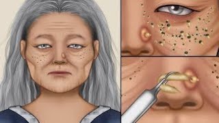 ASMR Canker sores cause of mouth ulcer treatment  Tonsil stone removal animation [upl. by Astra742]