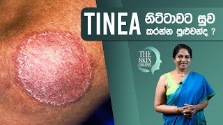 ඔබේ සමටත් දිලීර රෝගයක් Ringworm බෝවෙලාද  Dr Nayani Madarasinghe [upl. by Okimuy785]