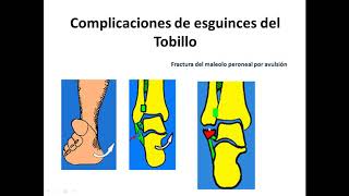 ESGUINCE DE TOBILLOS Y SU RECUPERACIÓN CON EJERCICIOS [upl. by Hew864]