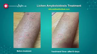 Successfull Lichen Amyloidosis Treatment Lichen Amyloidosis Cure 20192022 [upl. by Villada612]