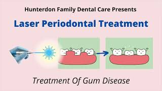 Laser Treatment of Periodontal Disease [upl. by Rramahs]