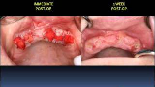 MANDIBULAR IMPLANT OVERDENTURE FABRICATION [upl. by Annoed]