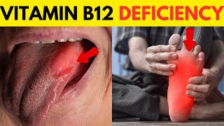 Vitamin B12 Deficiency Symptoms  B12 Deficiency  Vitamin B12  All You Need to Know [upl. by Eserehs]