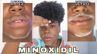 1 MÊS USANDO MINOXIDIL  ANTES E DEPOIS [upl. by Edahc66]