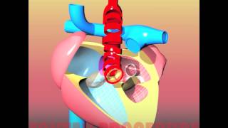 Congenital heart defects III HLHS  Hypoplastic Left Heart Syndrome [upl. by Negiam]