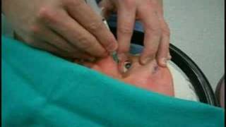 Retrobulbar injection for cataract surgery anesthesia [upl. by Elbring]