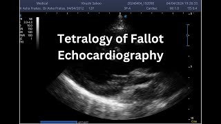 Tetralogy of Fallot  Point of Care ECHO  Short Video [upl. by Enitsahc59]