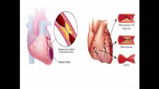 Acute coronary Syndrome مبدعووون  Dr Noha Yaseen [upl. by Hanid520]