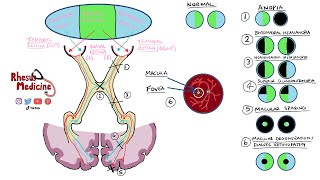 Visual Field Defects and Optic Nerve Pathway  Homonymous Hemianopia Bitemporal Hemianopia NEW 2020 [upl. by Whitaker]