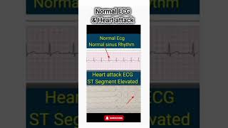 Normal ECG vs Heart Attack ECG Explained  Recognize the Signs of a Heart Attack [upl. by Tini]