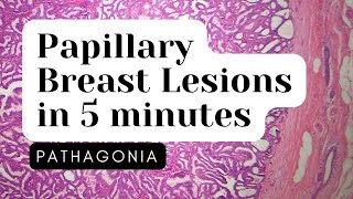 Papillary Neoplasms of Breast 5 Minute Overview pathagonia [upl. by Ssitruc]