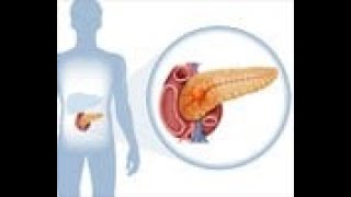 Insulinoma Pancreatic Tumor  Definition Causes Risk factors Symptoms Diagnosis Treatment [upl. by Nywde]