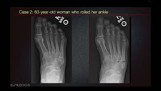 Sports Medicine Case 20 24yearold male An Unusual Presentation of Foot Pain in a Soccer Player [upl. by Aplihs]