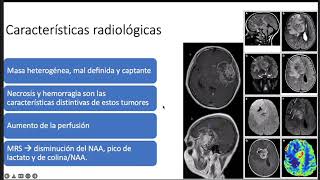 Glioma difuso de alto grado en pediatría Astrocitoma grado IV en pediatría [upl. by Finnegan]