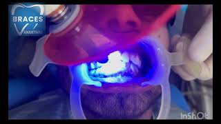 CLASS 2 DIV 1 MALOCCLUSION  BRACES  ORTHODONTICS trending dentist toothdental dentalcare [upl. by Ashman]