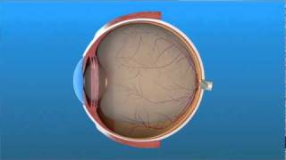 Vitrectomy Surgery for Detached Retina [upl. by Macario20]