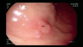 early gastric cancer [upl. by Airla]