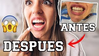 🔥 MI EXPERIENCIA CON EL BLANQUEAMIENTO DENTAL 😰 ¿ME DOLIO ¿PRECIO [upl. by Nahtnamas611]