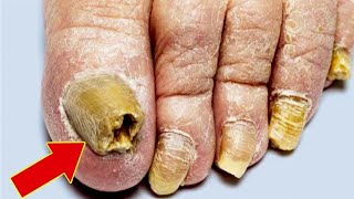 Isso é um exterminador de micose de unhas Funciona rápido demais😱 [upl. by Anola]