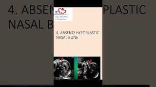 Absent or hypoplastic nasal bone an antenatal scan nasalbone hypoplasticnasalbone [upl. by Aiciruam]