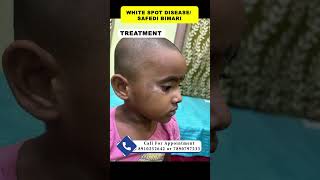 Vitiligo treatment  white spot disease safedi bimari druttamkumarlenka vitiligosafedi [upl. by Eniamraj602]