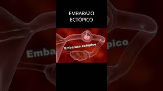 EMBARAZO ECTOPICO [upl. by Tichonn775]