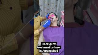 Black gum treatment by laser in Aurangabad gum depigmentation gingival bleaching melanosis treatmen [upl. by Shlomo705]