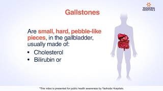 Gallstones  Cholelithiasis Symptoms Causes Diagnosis and Treatment [upl. by Kraul]