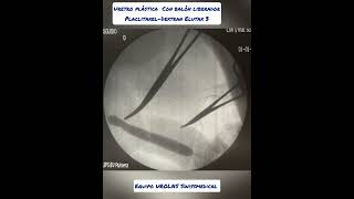 urethral stricture New successful application of Paclitaxel Dextran balloon balloonurethroplasty [upl. by Suivat]