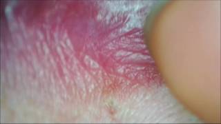 Espinilla gigante en el labio Lip blackhead [upl. by Ardnuaet]