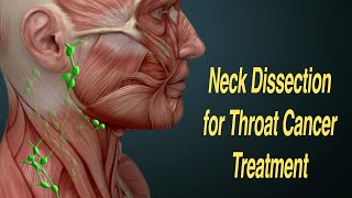 Neck Dissection Surgery for Throat Cancer Treatment MRND RND [upl. by Felton]