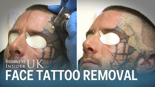 Watch This Man Have His Face Tattoo Removed From Laser Surgery  Business Insider [upl. by Anelac]