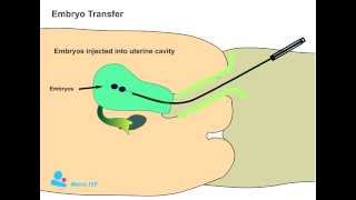 Embryo Transfer procedure [upl. by Steinberg854]