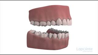 Conséquences dune malocclusion  Centres dentaires Lapointe [upl. by Mat]