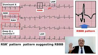 EKG Trainer Case 2 Answer CME internalmedicine ecg محاضراتباطنة امراضباطنة [upl. by Reddin]