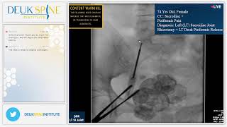 Sacroiliac Joint Rhizotomy for Sacroiliitis [upl. by Licna421]