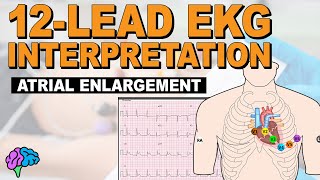 IDENTIFY Atrial Enlargement on 12Lead EKG [upl. by Kast616]