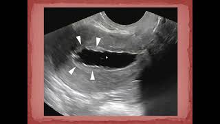 Saline infusion sonohysterography SIS [upl. by Voleta]