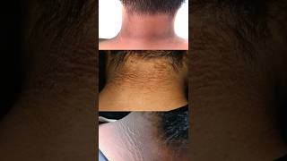 Dark Neck ProblemExpert Solution revealed by a Dermatologist darkneck darknecktreatment skincare [upl. by Freeborn462]