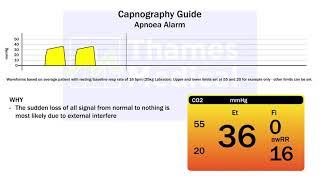 Capnography Waveforms Apnoea Alarm [upl. by Verge]