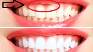 4 Natural Remedies You Need To Grow Back Receding Gums BeeNatural [upl. by Elok]