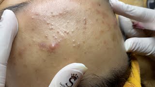 Forehead Acne And Pimples  Mụn Trán  SacDepSpa322 [upl. by Colson]